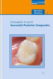Cover von Successful Posterior Composites